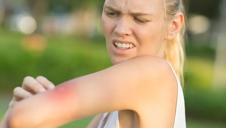 A woman looking at an inflamed mosquito bite on their arm.