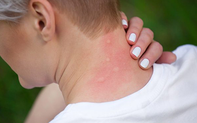 Bug bites on the neck.