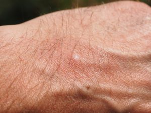 Image of a mosquito bite on a man's hand