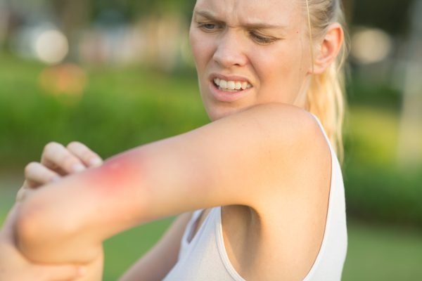 woman-with-mosquito-bite